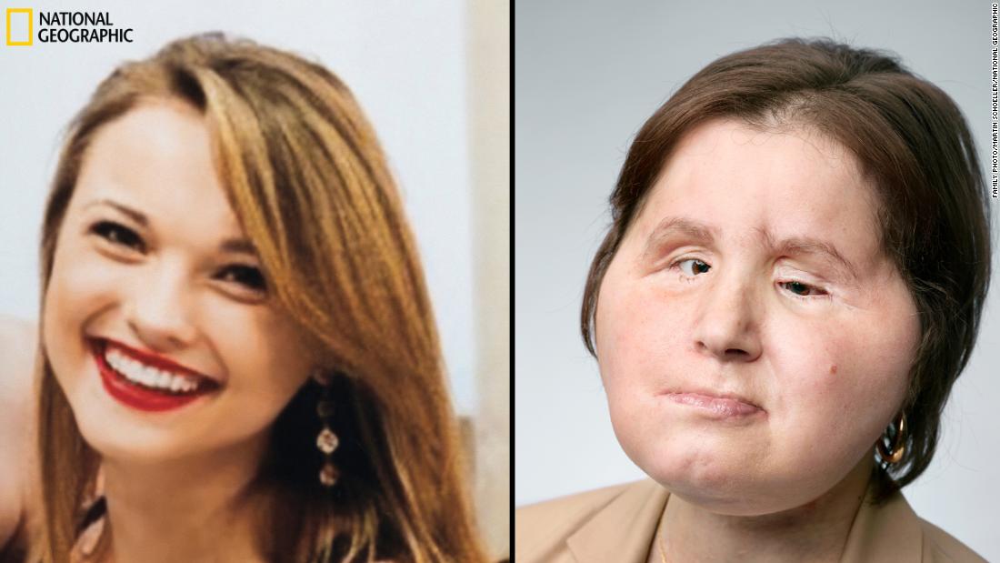 CNN's tweet photo. She's the youngest face transplant recipient in US history and now hopes to use her historic surgery to raise awareness about the lasting harms of suicide and the value of life. https://t.co/YMQwXneKSW https://t.co/1UZTx9T67u