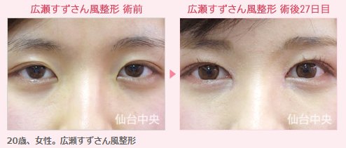 仙台中央クリニック美容整形美容外科 Sur Twitter 広瀬すずの整形 広瀬すず似の整形 広瀬すずになりたい 二重仙台 目頭切開仙台 埋没法 芸能人に似せたい 美容整形名医 広瀬すずさんは 大活躍の若手女優で 正統派の美人です 広瀬すず似の整形が可能です