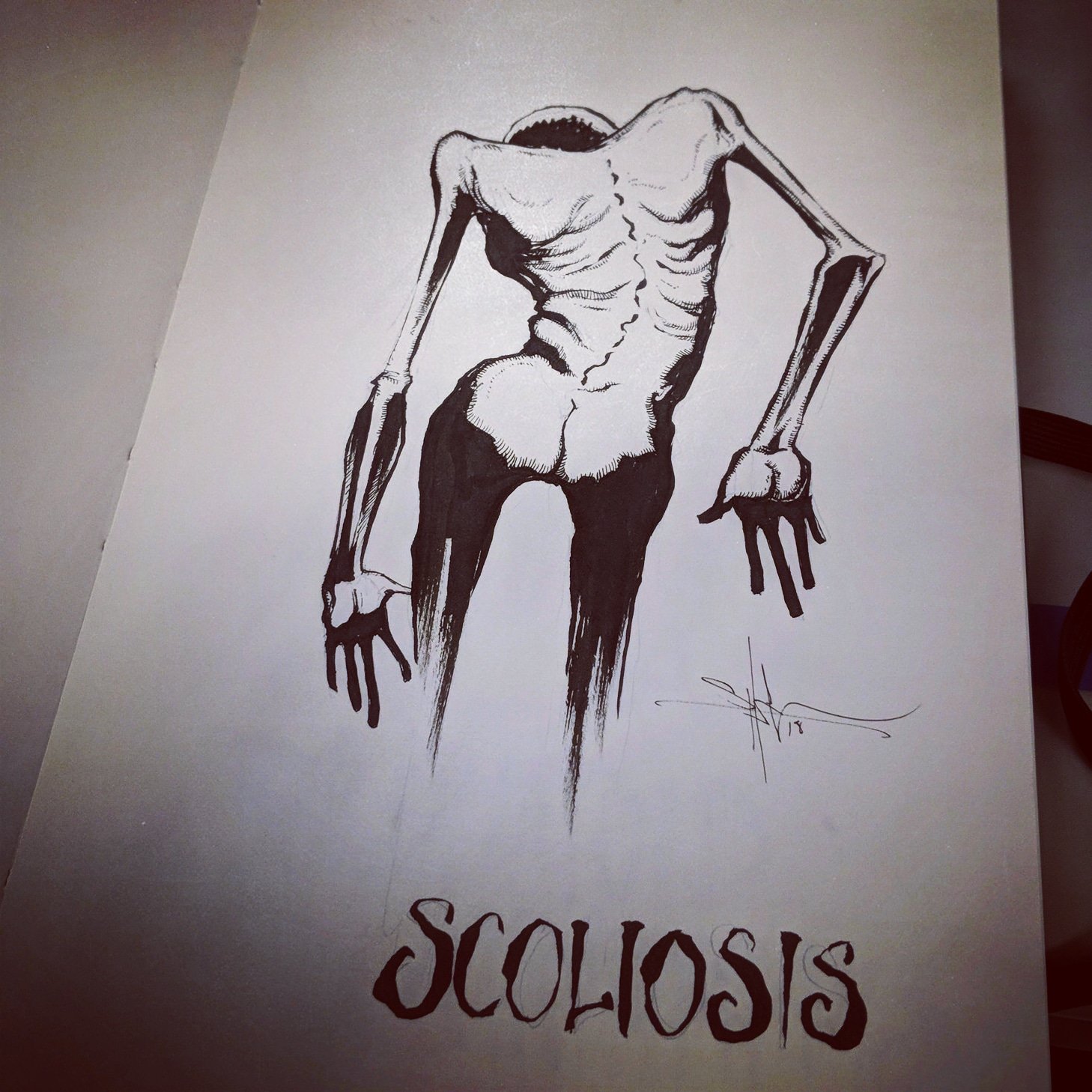 Shawn Coss on Twitter "Scoliosis 💉 Day 1 of August Ailments https//t