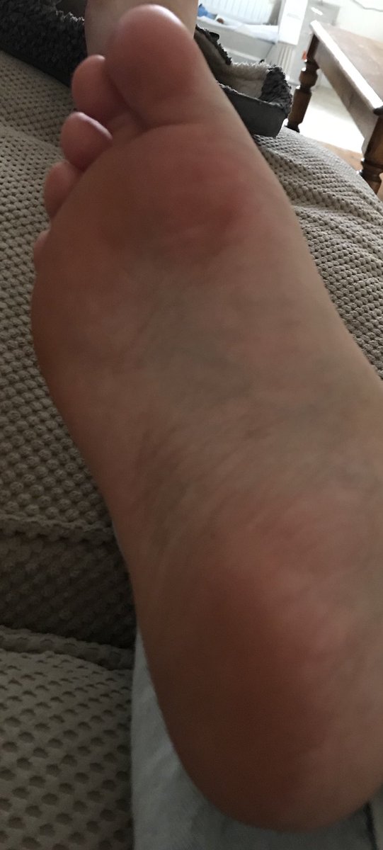 AmyJordan_90's tweet photo. @SchollIND I’m normally not one for reviews but I honestly can’t believe how amazing the Scholl Damage Repair Foot Cream is. My feet previous to this were cracked especially on my big toe and heals, to the point my feet were getting painful to walk on. Only my 2nd day in and WOW https://t.co/h1rh4uUq91