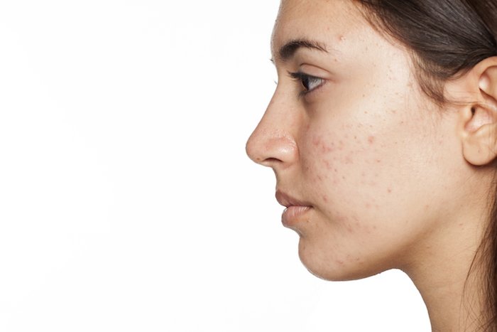 RobertPoeMD's tweet photo. Getting Rid of Acne Scars for Good
(https://t.co/H1t8KBU3VG)

#southport #brunswickcounty #acnescarring https://t.co/soFDHzqw5F