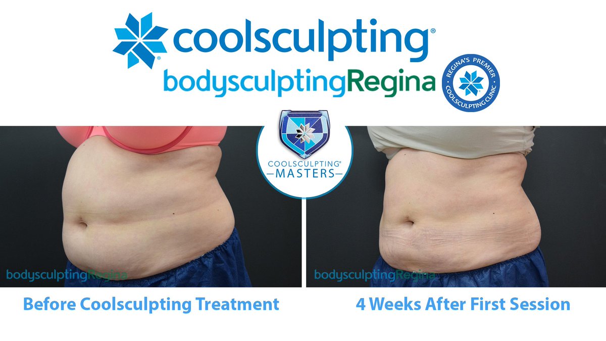 BodySculptYQR's tweet photo. AMAZING RESULTS! 🙌 Our patient had her full abdominal treated with CoolSculpting ❄️ & has seen great results after only 30 Days First Treatment.
#CoolSculptingMasters #CoolSculpting #realPatient #realResults #Regina #YQR #YQRBeauty #YQRFashion #QueenCity #BodySculptingRegina https://t.co/IvEgBQb6AQ