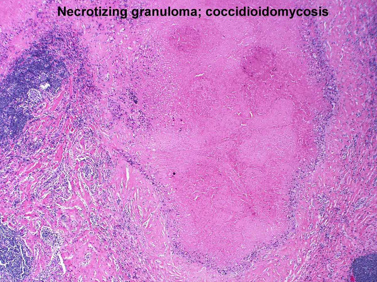 PathTweetorial-Granuloma Formation 5/6
Granulomas may be non-necrotizing or necrotizing with variable amounts of necrosis. Necrosis usually indicates an infectious etiology. However, necrosis may also occur in non-infectious diseases such as GPA, RA, sarcoidosis and others.