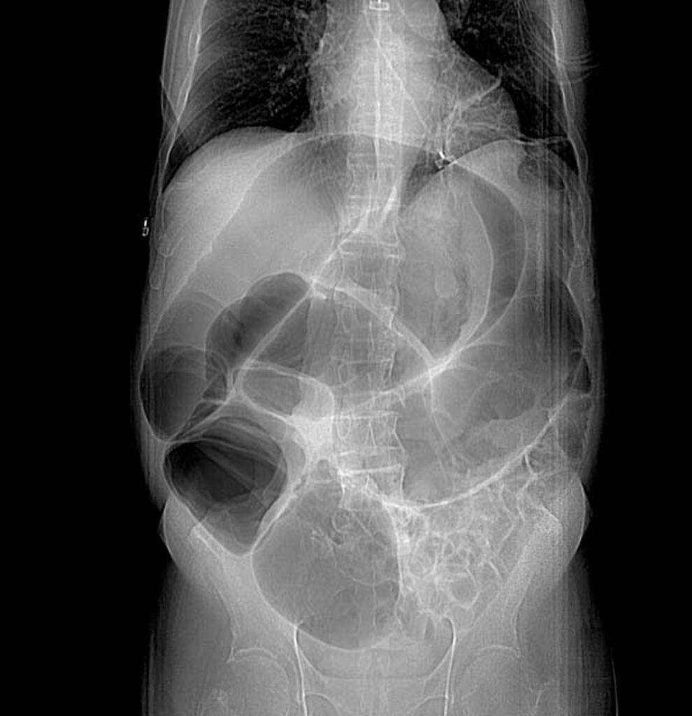 SurgeryLegends's tweet photo. Ogilvie syndrome, pseudo-obstruction of the colon, was described in 1948 by Sir William Heneage Ogilvie (1887-1971). Born in Chile to British parents, he trained in England and was on staff at Guy’s Hospital in London, and served in the Balkan War and World War I and II. https://t.co/dOZkKLSneq