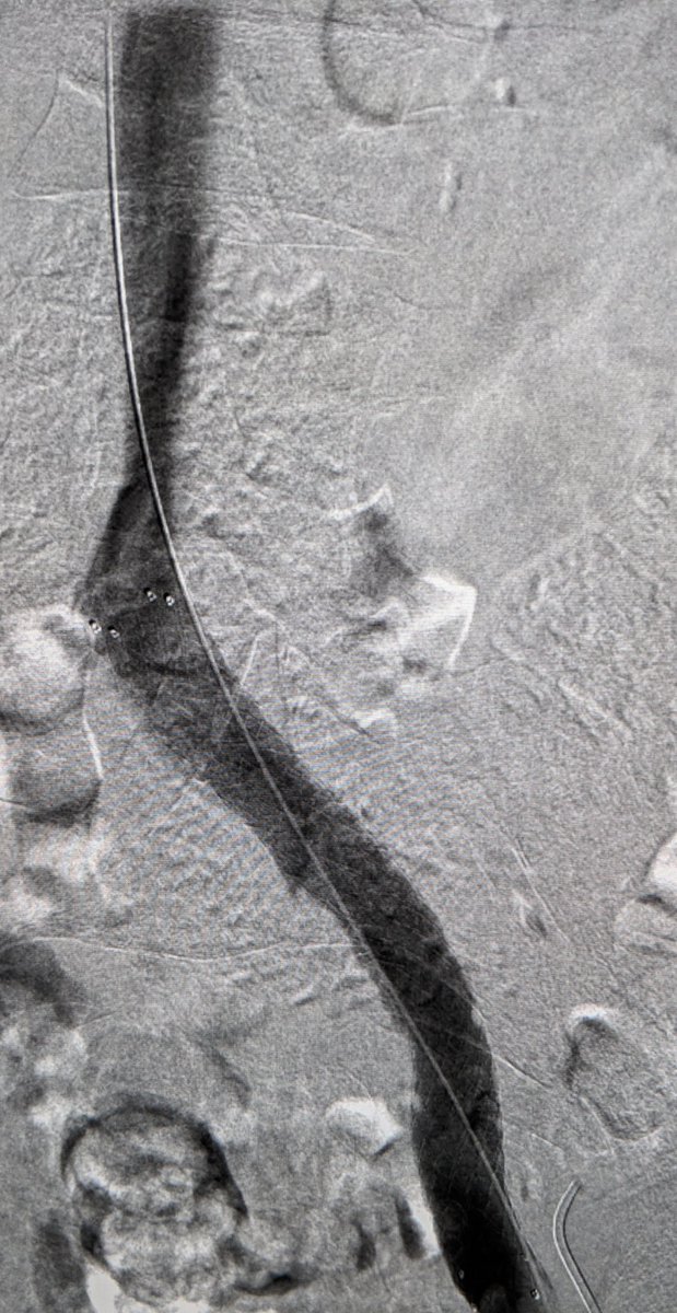 LessneVIR's tweet photo. Clotted thigh AVG, acute clot in ext Iliac v & CHRONIC com Iliac vein occlusion. Fem v access for Iliac recan, then AVG declot (w #Zelante), finish w iliac stent. Successful dialysis next day! #SaveTheAccess @CLTRadiology #IRad (already planning for chest recan #Stay1StepAhead) https://t.co/gzVedDohGi