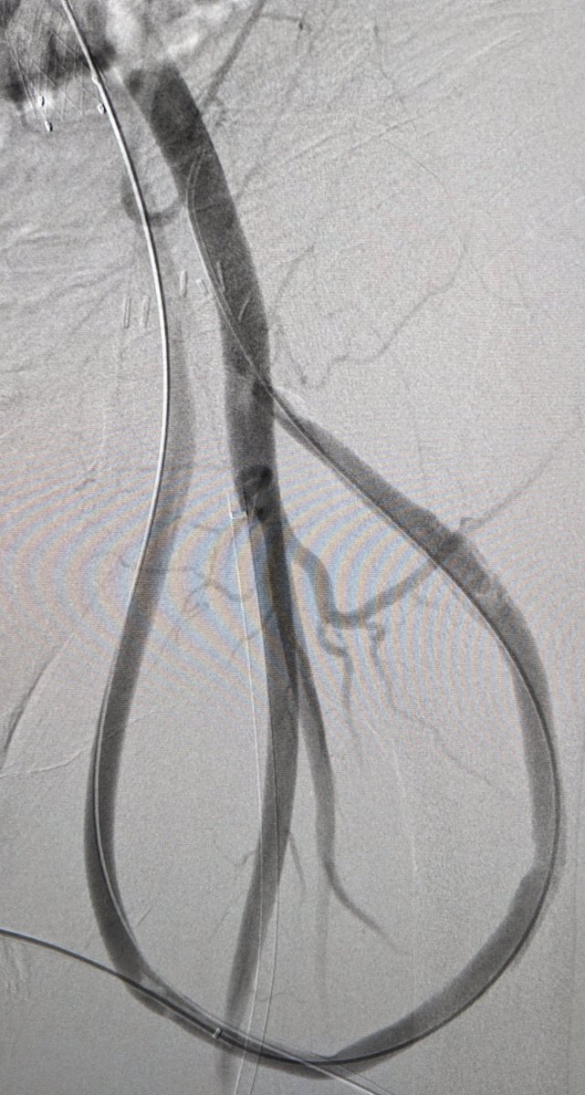 LessneVIR's tweet photo. Clotted thigh AVG, acute clot in ext Iliac v & CHRONIC com Iliac vein occlusion. Fem v access for Iliac recan, then AVG declot (w #Zelante), finish w iliac stent. Successful dialysis next day! #SaveTheAccess @CLTRadiology #IRad (already planning for chest recan #Stay1StepAhead) https://t.co/gzVedDohGi