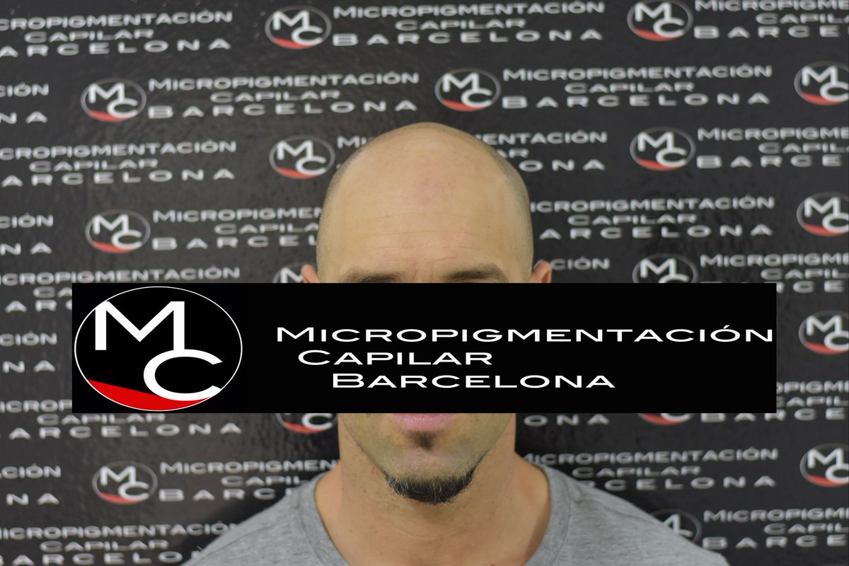 micropigcapibcn's tweet photo. Actualizamos con una fotografía del antes y después de un tratamiento.
¡Otro de nuestros clientes satisfechos con la Micropigmentación Capilar!
¡Tu satisfacción es nuestro mejor trabajo!
Para más información no dudéis en contactarnos:
Teléfono: 93.019.88.04
Whatsapp: 600.63.46.16 https://t.co/6hipJlgwQY