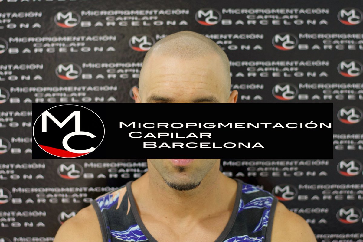 micropigcapibcn's tweet photo. Actualizamos con una fotografía del antes y después de un tratamiento.
¡Otro de nuestros clientes satisfechos con la Micropigmentación Capilar!
¡Tu satisfacción es nuestro mejor trabajo!
Para más información no dudéis en contactarnos:
Teléfono: 93.019.88.04
Whatsapp: 600.63.46.16 https://t.co/6hipJlgwQY