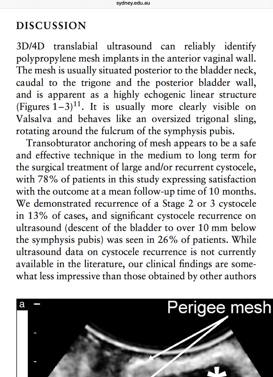 FibroidNetwork's tweet photo. @chrisharding123 @ElneilSuzy 2008 Sydney #Australia study: ‘Transobturator #Mesh for Cystocele Repair: A Short to Medium term follow up using 3D/4D’ #Translabial ultrasound with Perigee Mesh (AMS). It also showed when mesh had folded. 13% prolapse recurred @chrisharding123 @ElneilSuzy https://t.co/qsCSJ3PkHG https://t.co/I9Hzbz3PXq