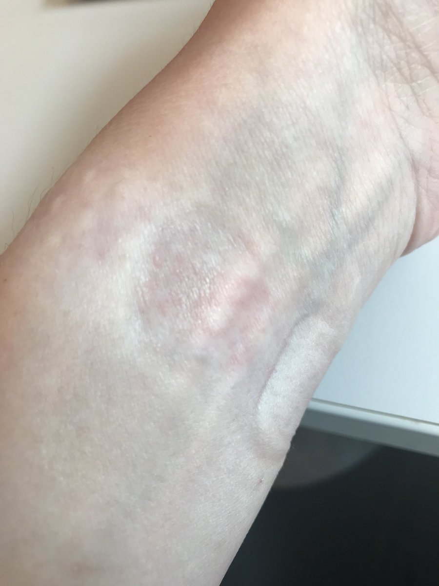 DRsonosRD's tweet photo. #dermpearls #meded This is what contact dermatitis looks like. Knew I shouldn’t have tried to save $ with an 8 dollar online Apple Watch band 😂 ! https://t.co/NQT6X5s60P