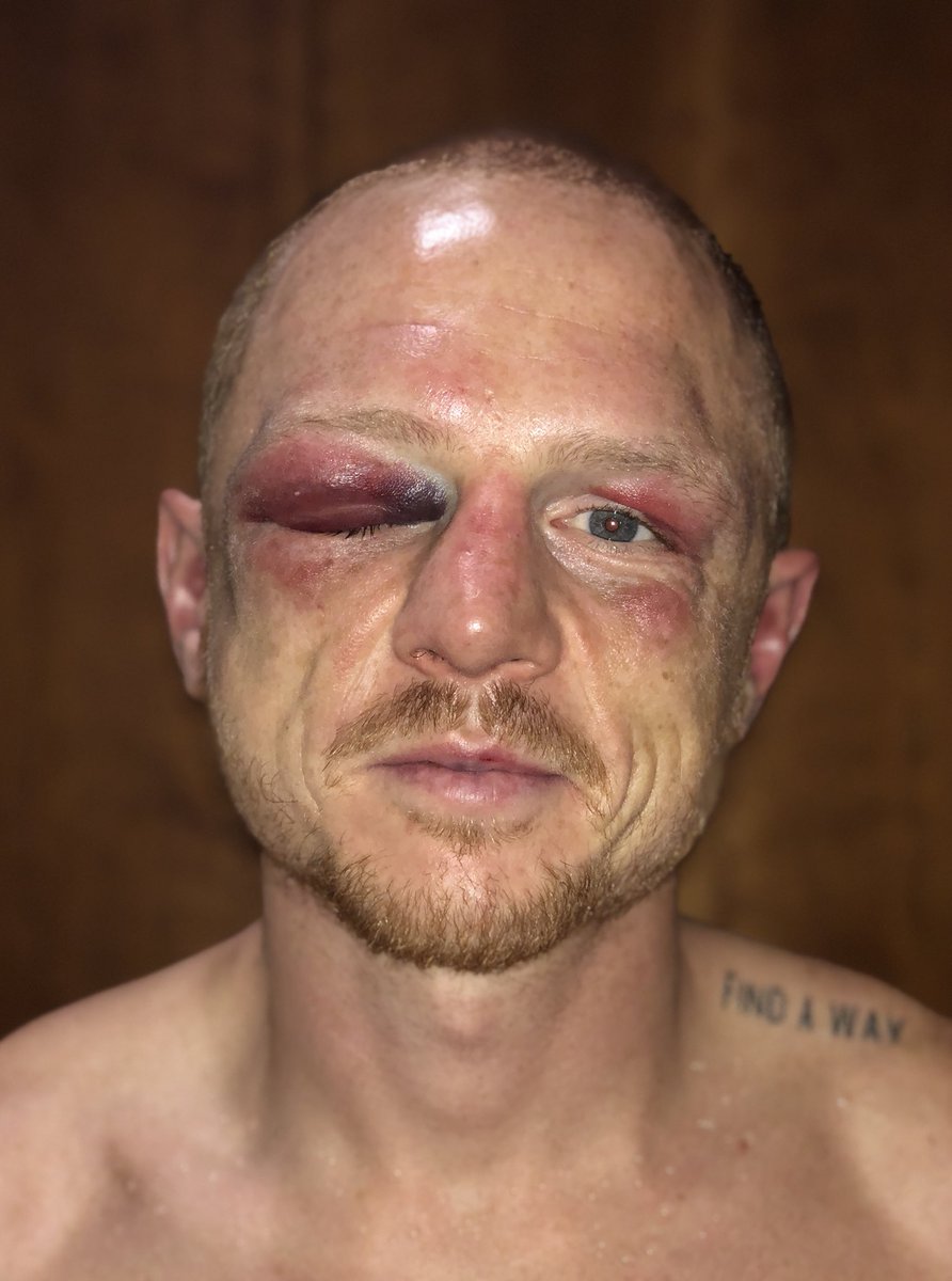 LukeJackson's tweet image. You don’t play boxing! Two perforated ear drums - left ear in round 3, right ear in round 6 and then the body shot in round 8. I wanted to finish the fight but I respect my coach and my team’s decision. I’ll live to fight another day 🙏🏼