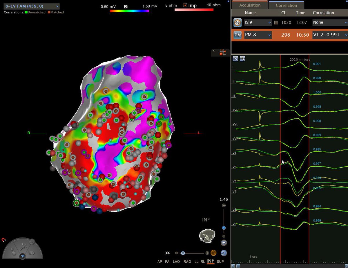 Inferior view of an ischemic VT. We had a 99% #PASO correlation match- shown to the right. Lots of substrate but the clinical VT was not seen again. Patient had a large area of the heart that was akinetic and seen on ICE with #CARTOsound. #CARTOv6 #biosensewebster #mycompany