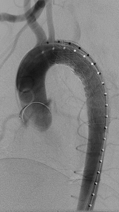 Blunt aortic injury (BAI) &amp; repair. Heneghan et al suggest simplified SVS grading criteria based on tx differences. Thoughts? Minimal=nonoperative. Moderate=semielective TEVAR. Severe=emergency TEVAR. (J Vasc Surg 2016;64:171-6.) <a href="/SIRRFS/">SIR RFS</a> <a href="/SIRspecialists/">Society of Interventional Radiology</a> <a href="/JVIRmedia/">JVIR</a>