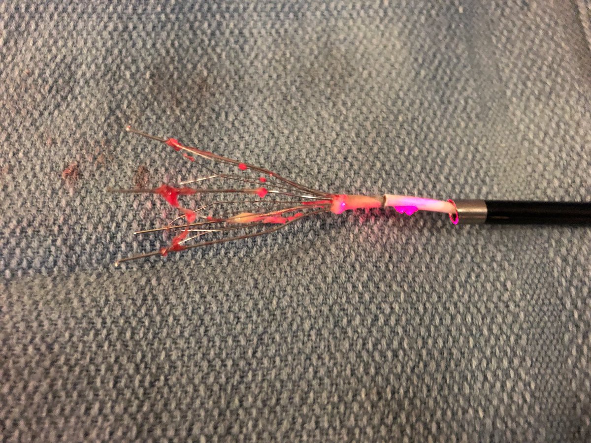 Kush Desai (@kush_r_desai) on Twitter photo 7 yo #filterOUT with “laser” <a href="/NorthwesternIR/">NorthwesternIR</a>. Learn more about filter retrieval and the latest and greatest in VTE management <a href="/SIRspecialists/">Society of Interventional Radiology</a> #ACTiVE18 in Chicago, 9/27-9/29, early registration rates still available buff.ly/2IupC2c <a href="/rkryu/">RK RYU</a> 7 yo #filterOUT with “laser” <a href="/NorthwesternIR/">NorthwesternIR</a>. Learn more about filter retrieval and the latest and greatest in VTE management <a href="/SIRspecialists/">Society of Interventional Radiology</a> #ACTiVE18 in Chicago, 9/27-9/29, early registration rates still available buff.ly/2IupC2c <a href="/rkryu/">RK RYU</a>