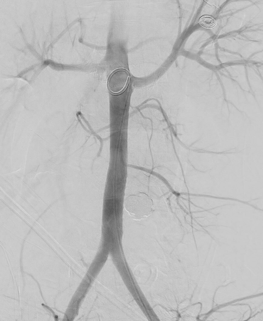TheRealDoctorOs's tweet photo. Trauma with ruptured aorta on table —> Not on my watch 😆 #irad @UChicagoRADS @UChicagoIR https://t.co/p3xgQP8Fqm