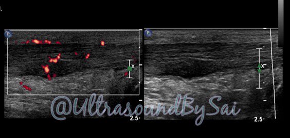 UltrasoundBySai's tweet photo. Paciente masculino con dolor en practica deportiva (atletismo) refiere dolor
Tendinopatia focal del Tendón de Aquiles.
#Aquiles #MSKUS #ultrasounbysai #tobillo #tendon #tendinopathy #dopplercolor https://t.co/Vfd1zCmkpR