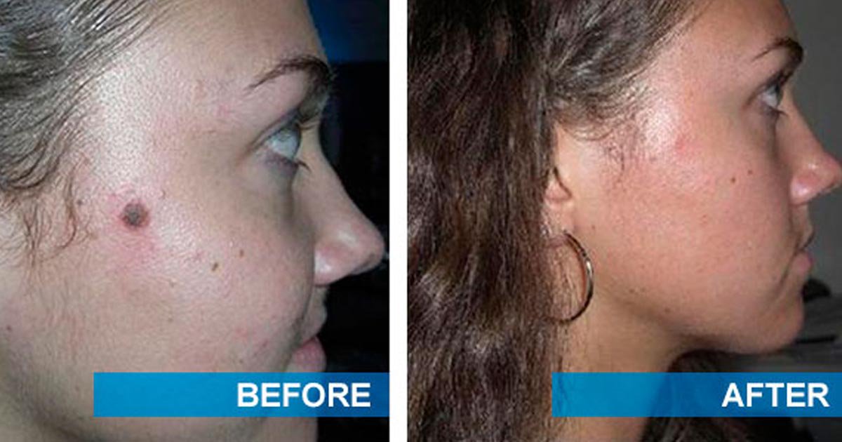 facial-mole-removal-scarring