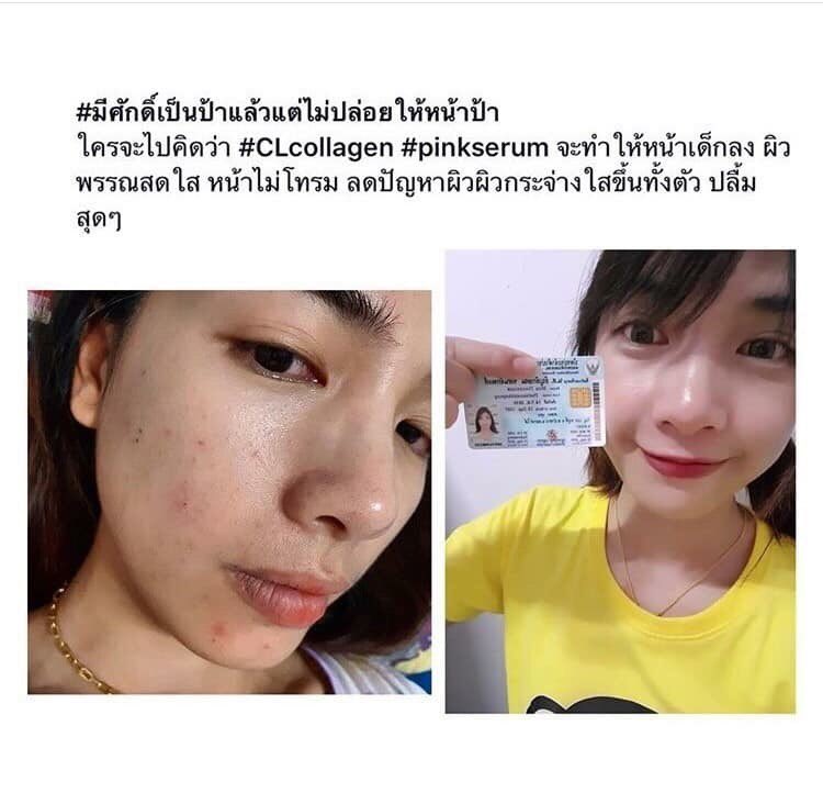 chalisa_tannak's tweet photo. ฟื้นฟูผิวแบบเร่งด่วน ให้สุขภาพดี
ผิวดีระยะยาว ไม่ต้องเจ็บตัวฉีดแพงๆ
....
➡1ชอง 250฿ ผิวก็ดีได้
โปร2แถม1จ่าย 500฿ 🔥🔥 https://t.co/Or79HTPCrb