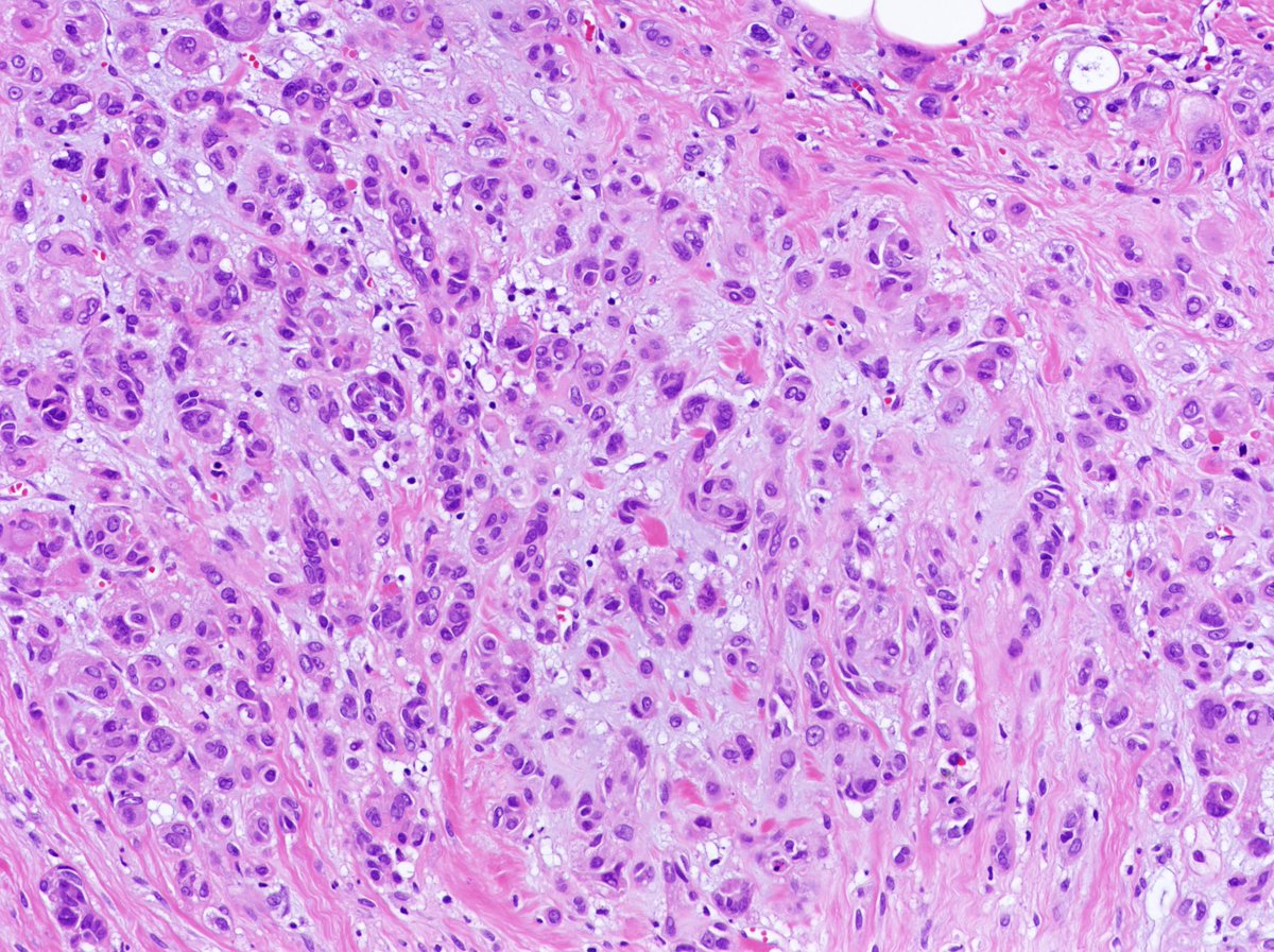 Patholwalker's tweet photo. Matrix-producing carcinoma. Breast, mastectomy. HE and S-100. #pathology #Breastpath https://t.co/OrHJkDk98T