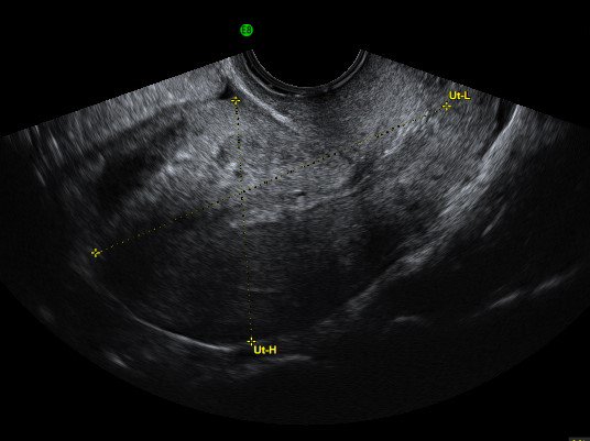 thescanningroom's tweet image. With our Fertility and Gynaecology scans we can perform a pelvic scan if you just want to have an 'mot' to see that everything appears as it should or if you have specific concerns - a doctors referral is not required.
ow.ly/f6Ra30lvYCA
#uterus #pelvicscan #fertility #ivf