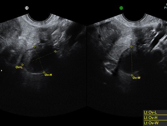 thescanningroom's tweet image. With our Fertility and Gynaecology scans we can perform a pelvic scan if you just want to have an 'mot' to see that everything appears as it should or if you have specific concerns - a doctors referral is not required.
ow.ly/f6Ra30lvYCA
#uterus #pelvicscan #fertility #ivf
