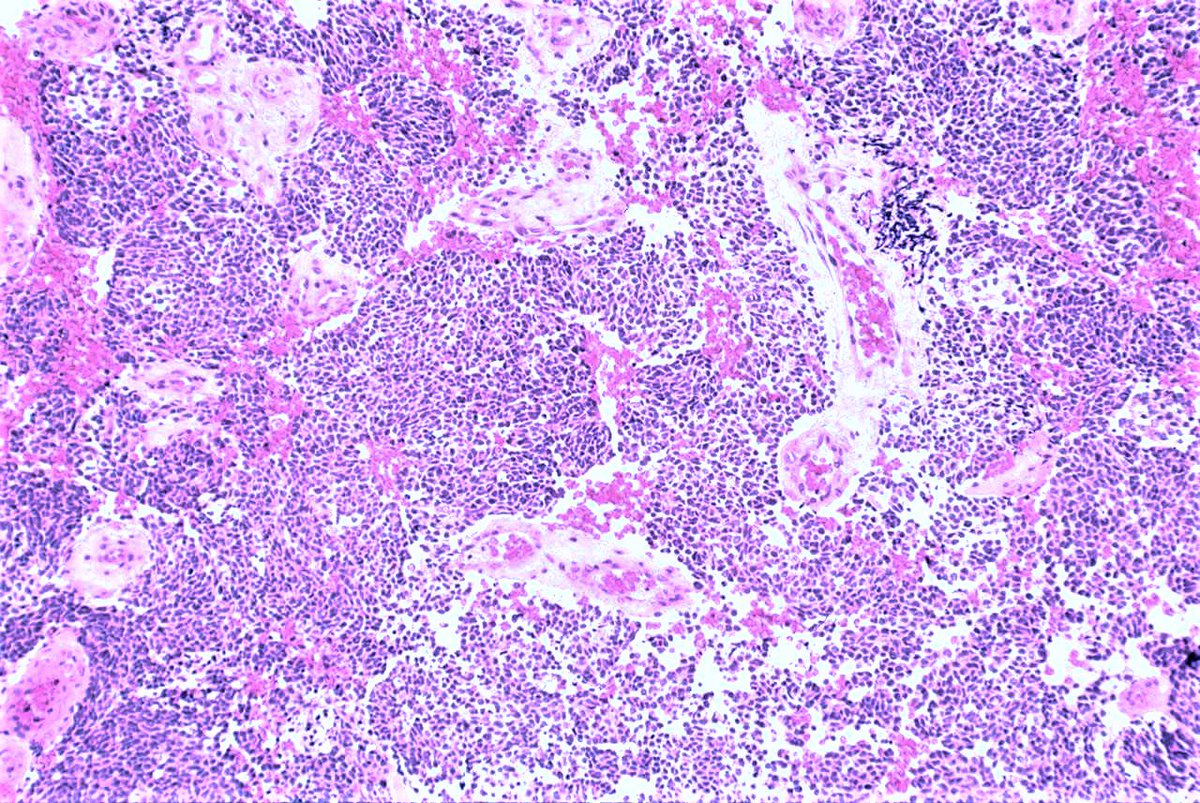 Patholwalker's tweet image. Medulloblastoma, NOS, WHO grade IV. Cerebellum, tumorectomy. HE and GFAP. #pathology #neuropath
