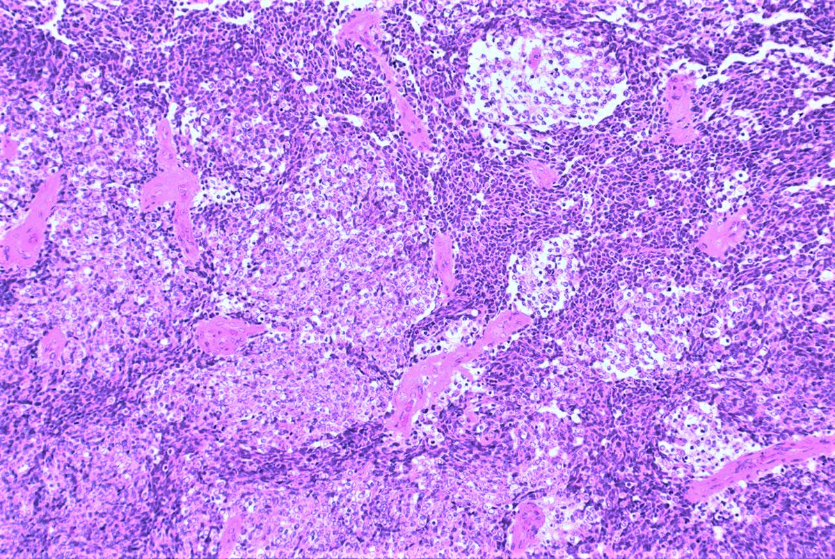 Patholwalker's tweet image. Medulloblastoma, NOS, WHO grade IV. Cerebellum, tumorectomy. HE and GFAP. #pathology #neuropath