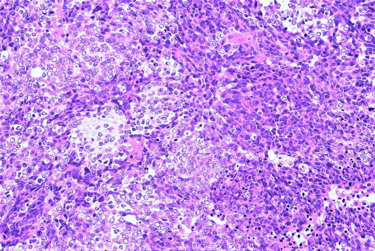 Patholwalker's tweet image. Medulloblastoma, NOS, WHO grade IV. Cerebellum, tumorectomy. HE and GFAP. #pathology #neuropath