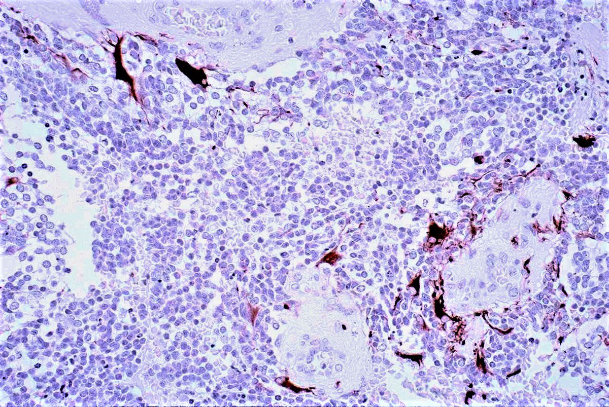 Patholwalker's tweet image. Medulloblastoma, NOS, WHO grade IV. Cerebellum, tumorectomy. HE and GFAP. #pathology #neuropath