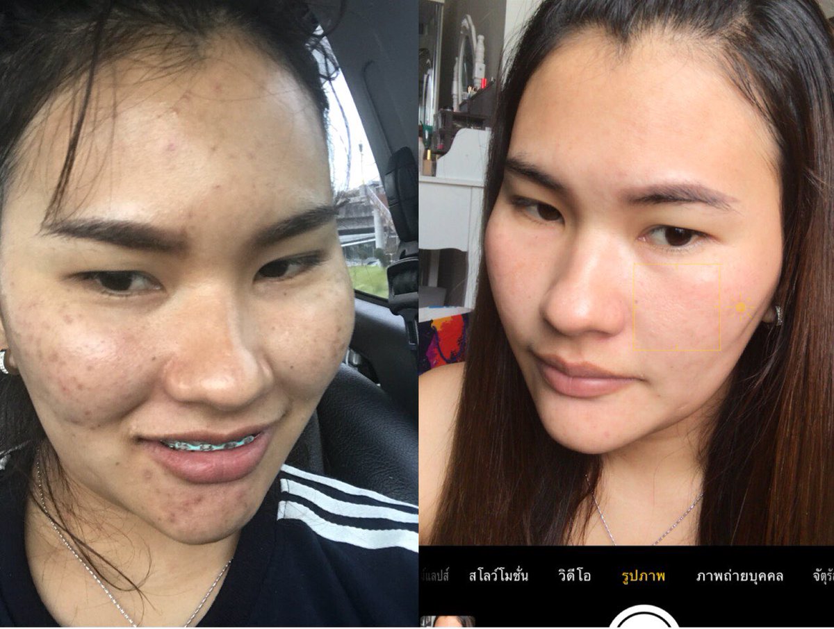 araya_cy's tweet photo. รีวิวคลอดแล้ว
หลังจากซุ่มใช้มานาน 
ส่วนตัวเราเห็นผลตั้งแต่เซทแรก สิวอักเสบ สิว���ด ดีขึ้น จนตอนนี้หายเกลี้ยง ไม่ทิ้งรอยดำ รอยแดง เอาไป10/10 
เราใช้ที่ล้างหน้าของเซตาฟิล และที่เช็ดหน้าของ Bioderma ด้วย
แนะนำจากใจใครที่เป็น��ิวลองดูนะ เราตามมาจากทวิต #howtoperfect ไอเท็มเด็ดรักษาสิว https://t.co/oay4K0NMHe