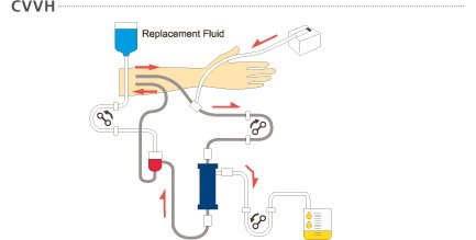 CliniNephrology's tweet photo. #Interesting The Risk-Adjusted Impact of Intraoperative Hemofiltration on Real-World Outcomes of Patients Undergoing #Cardiac Surgery
Get to know more updates on clinical Nephrology on our journal @ https://t.co/n0VK3XZGwq https://t.co/ZA8fHl8zib