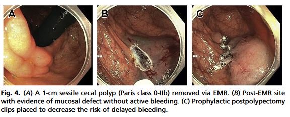 Gastro_Clinics's tweet image. From "Prevention of Recurrent Lower Gastrointestinal #Hemorrhage" by Shivani Gupta and David A. Greenwald, July 2018 Gastrointestinal #Endoscopy Clinics.
bit.ly/2MK5o7W #GIbleeding