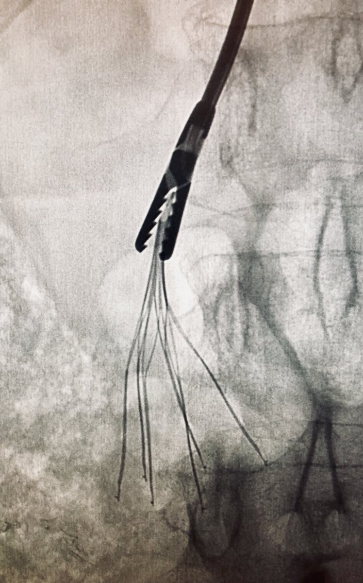 AlexCVIR's tweet photo. Filter Out Thursday?!??!? History of #TipEmbedded Option Elite Filter which is no longer needed. #FilterOut #ComplexFilterRetrieval #EndobronchialForceps #ACTiVE18 @medravi @kush_r_desai @JonnyMoriarty @CHICKVIR @jmcoopermd @KyleCooperMD @JBundyRad @SIRRFS @LessneVIR @Watts_IR https://t.co/zLcatLCWpI