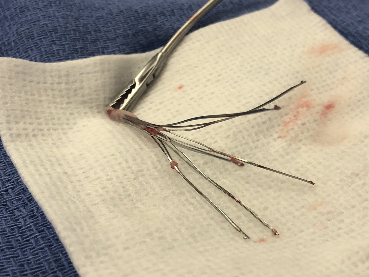 AlexCVIR's tweet photo. Filter Out Thursday?!??!? History of #TipEmbedded Option Elite Filter which is no longer needed. #FilterOut #ComplexFilterRetrieval #EndobronchialForceps #ACTiVE18 @medravi @kush_r_desai @JonnyMoriarty @CHICKVIR @jmcoopermd @KyleCooperMD @JBundyRad @SIRRFS @LessneVIR @Watts_IR https://t.co/zLcatLCWpI