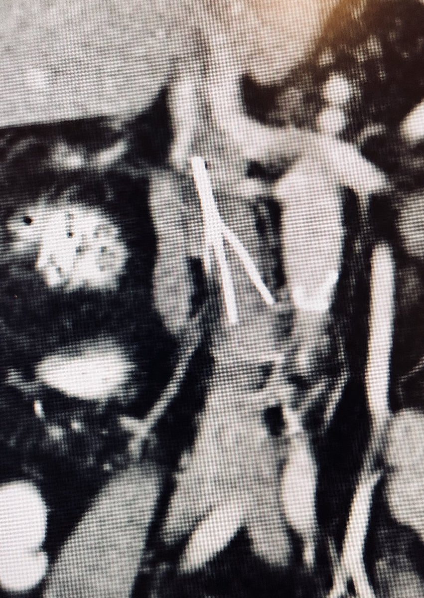 AlexCVIR's tweet photo. Filter Out Thursday?!??!? History of #TipEmbedded Option Elite Filter which is no longer needed. #FilterOut #ComplexFilterRetrieval #EndobronchialForceps #ACTiVE18 @medravi @kush_r_desai @JonnyMoriarty @CHICKVIR @jmcoopermd @KyleCooperMD @JBundyRad @SIRRFS @LessneVIR @Watts_IR https://t.co/zLcatLCWpI