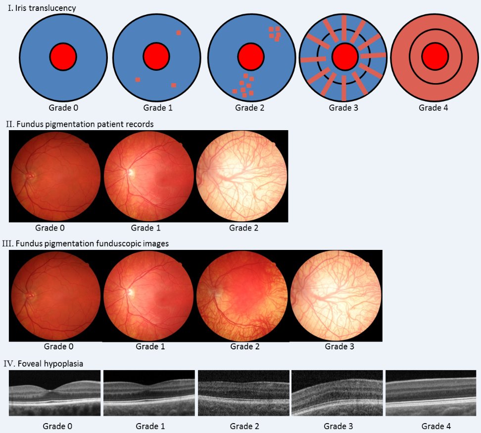 The phenotypic spectrum of albinism ow.ly/YKfF30lqKKZ