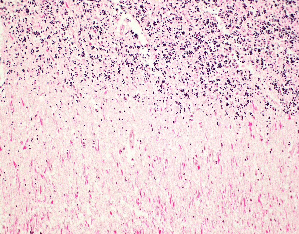 A case of Alexander disease. neuropathologyblog.blogspot.com/2018/08/a-case…
