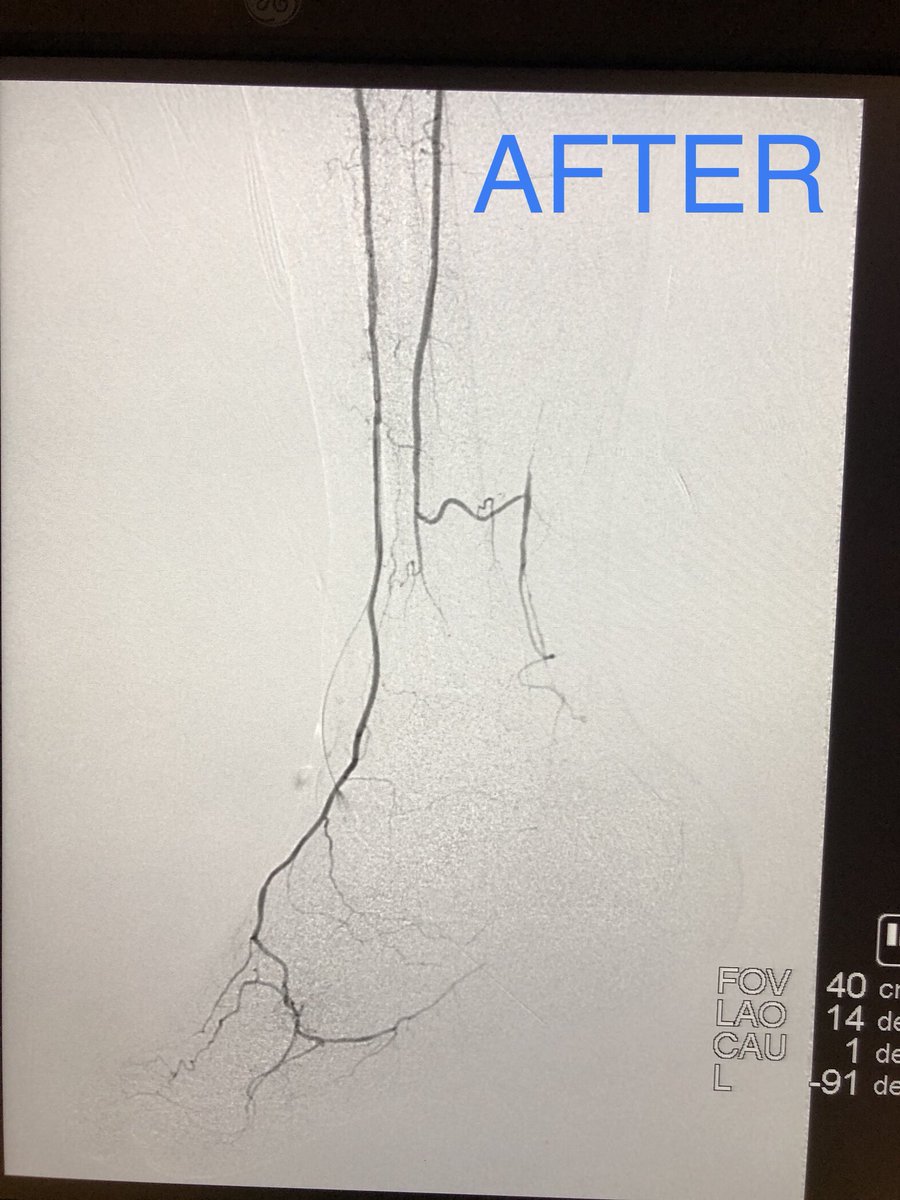 First SAFARI as an attending with great help from my fellow, <a href="/NvrTellMeTheOdd/">BCoombs</a>. 73 year old with delayed wound healing following first toe amputation. <a href="/UICOMPRadiology/">UICOMP Radiology</a> <a href="/SIRspecialists/">Society of Interventional Radiology</a> <a href="/SIRRFS/">SIR RFS</a>