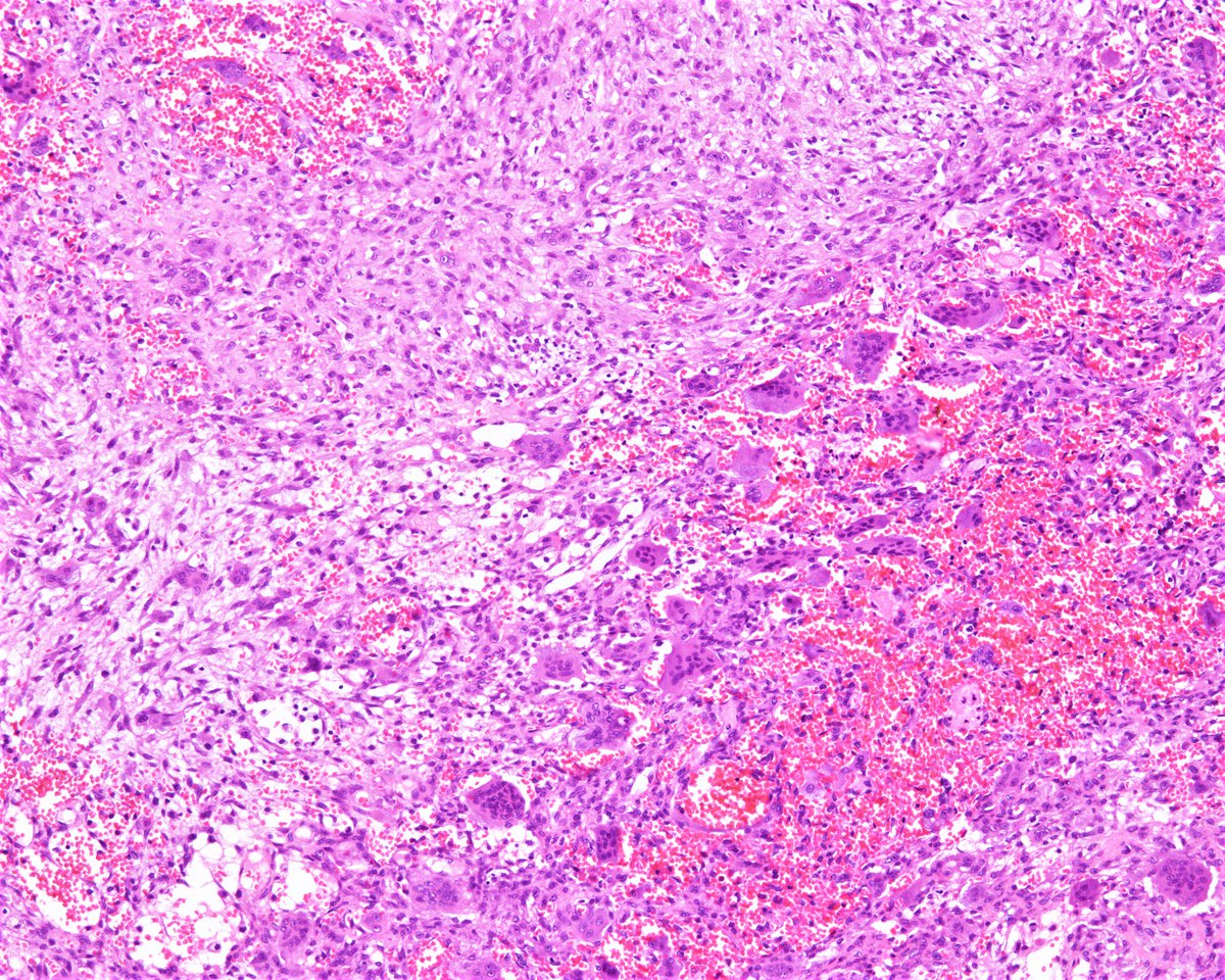 Patholwalker's tweet image. Aneurysmal bone cyst. Humeral bone, curettage. HE stain. #pathology #BSTpath