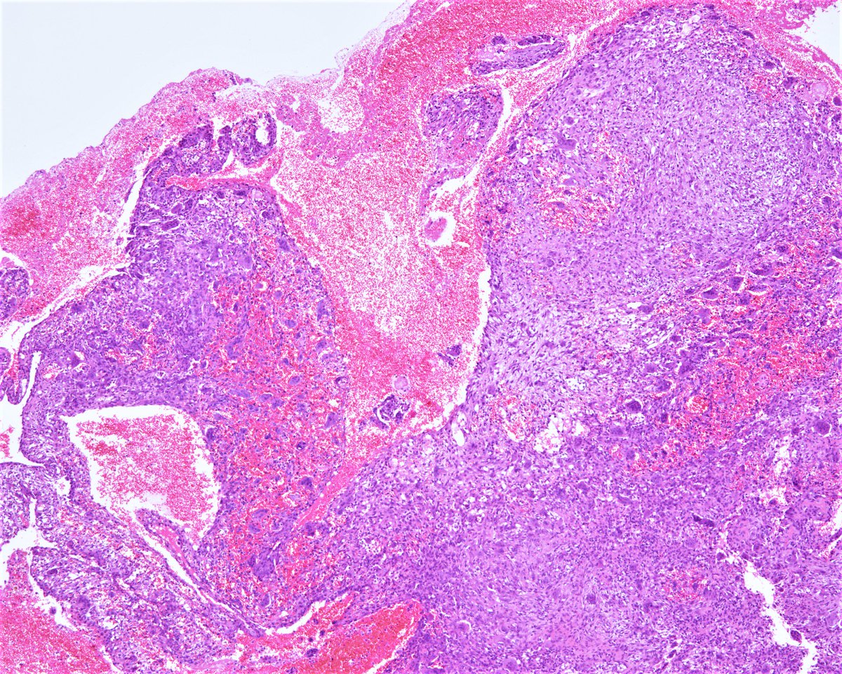 Patholwalker's tweet image. Aneurysmal bone cyst. Humeral bone, curettage. HE stain. #pathology #BSTpath