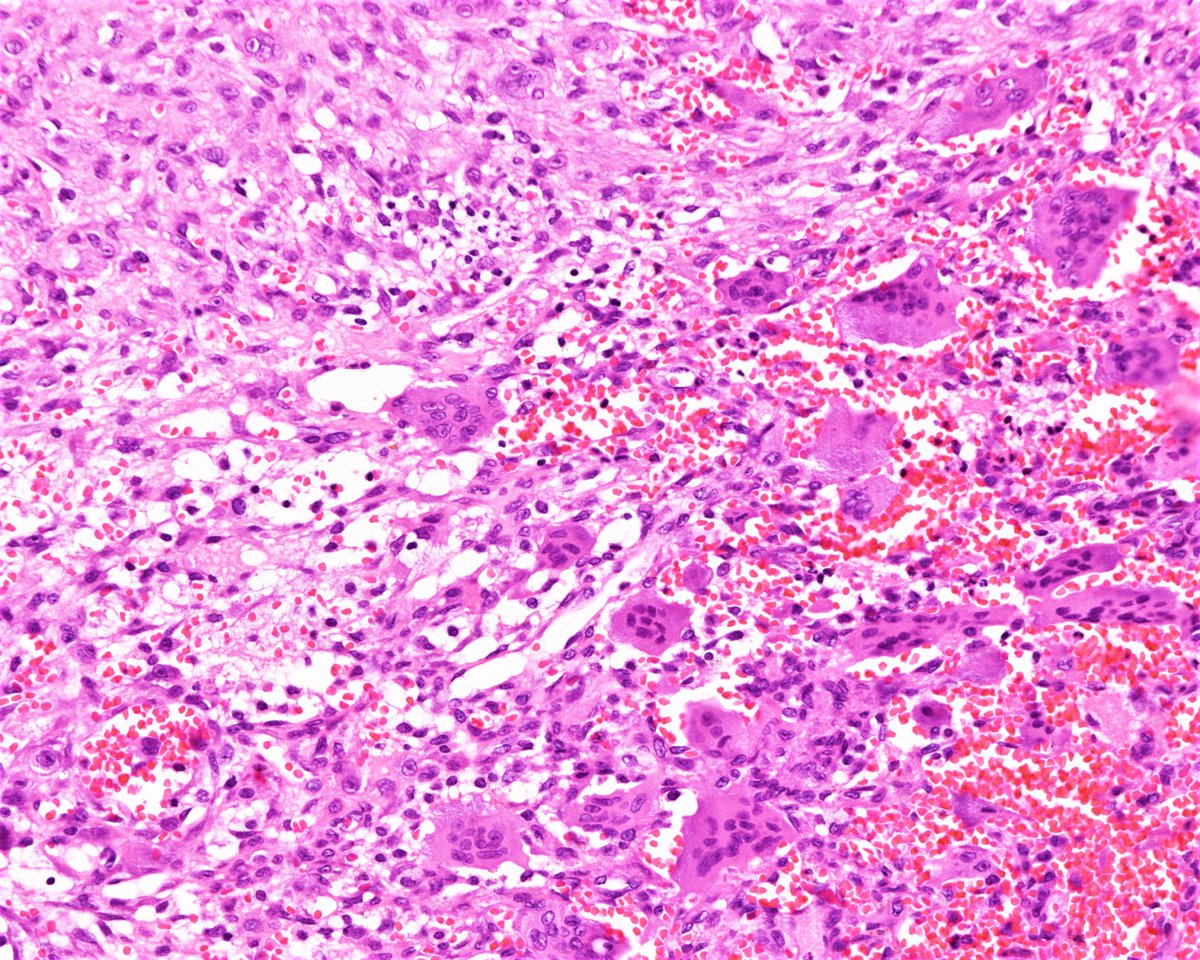 Patholwalker's tweet image. Aneurysmal bone cyst. Humeral bone, curettage. HE stain. #pathology #BSTpath