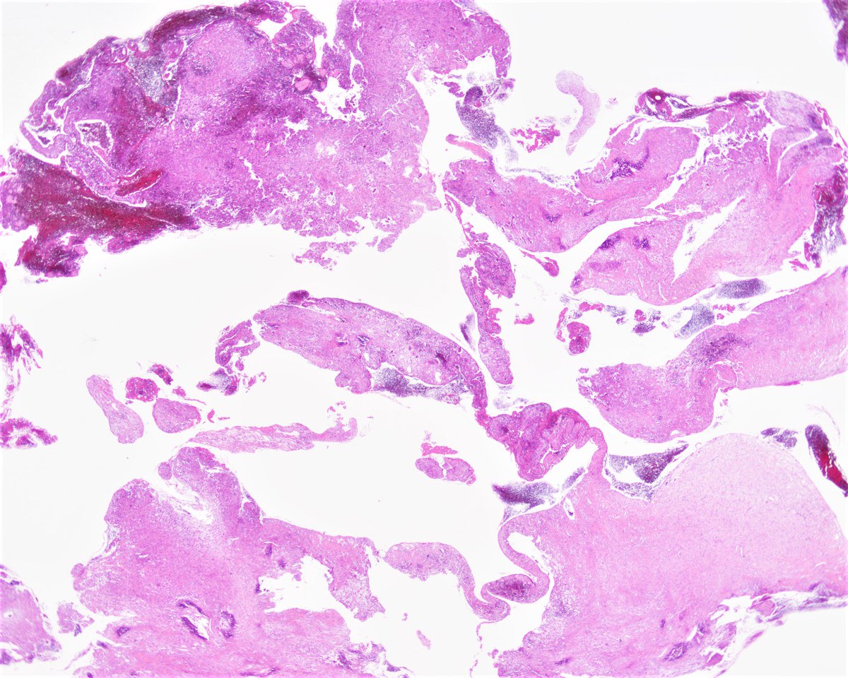 Patholwalker's tweet image. Aneurysmal bone cyst. Humeral bone, curettage. HE stain. #pathology #BSTpath