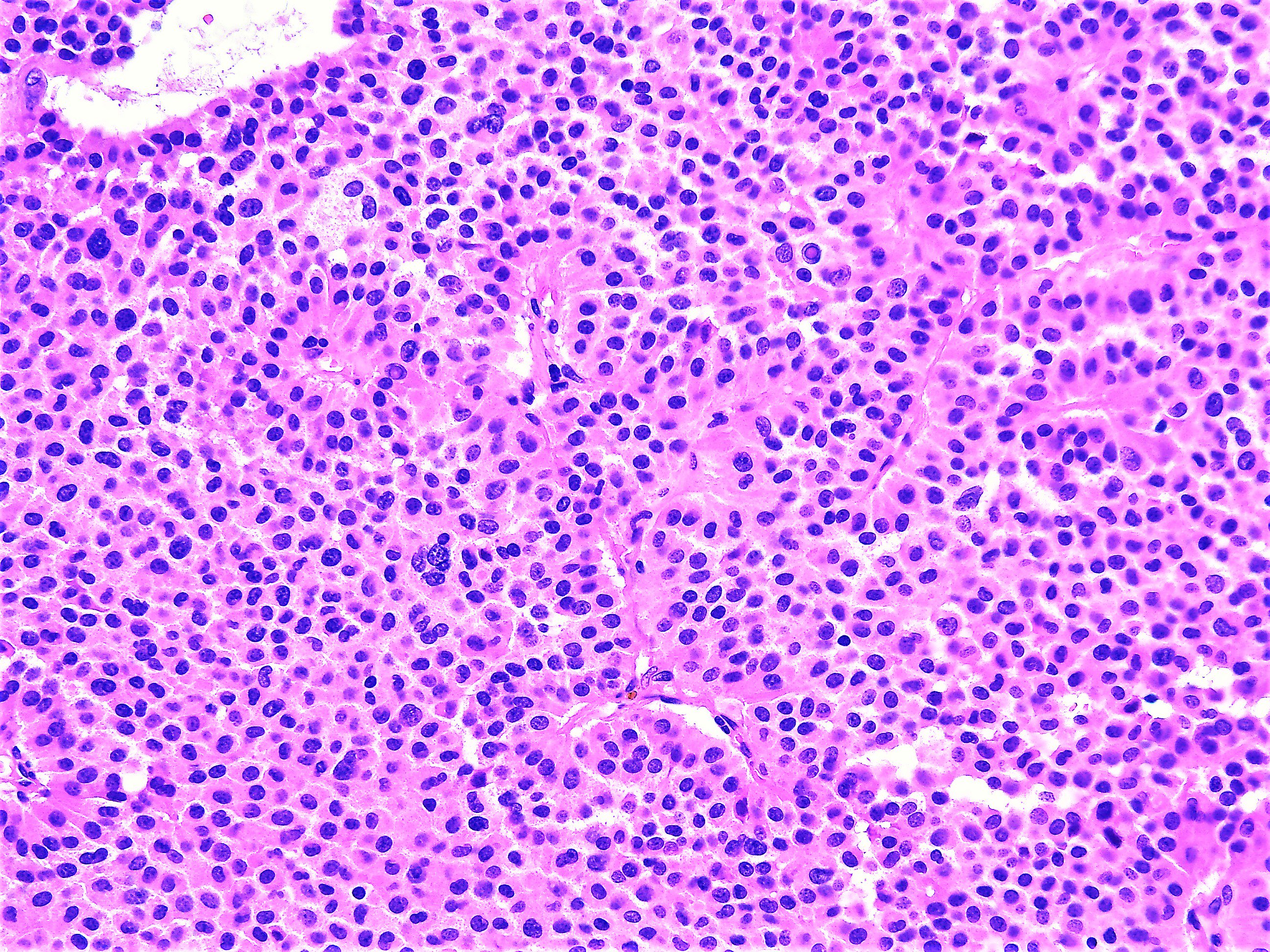 adenoma hypophysis pathology)