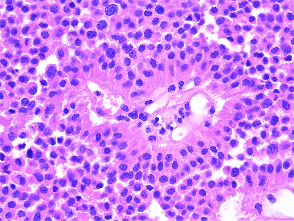 Patholwalker's tweet image. Pituitary adenoma. Pituitary gland, hypophysectomy. HE and lutenizing hormon. #pathology #Neuropath #Endopath