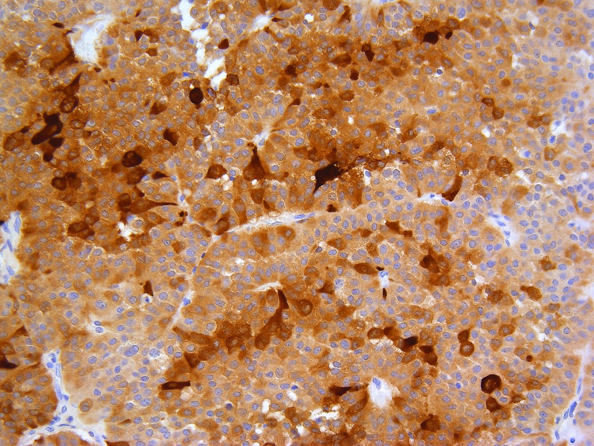 Patholwalker's tweet image. Pituitary adenoma. Pituitary gland, hypophysectomy. HE and lutenizing hormon. #pathology #Neuropath #Endopath