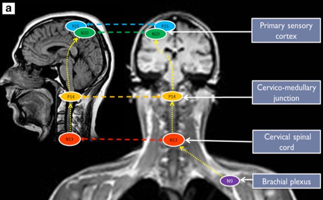 GENeR_Paris's tweet photo. Publications from the #GENeR about #BrainstemDysfunction in #DeeplySedated #ICU patients: 
CCM 2011 https://t.co/NmFs92M41M
Clinical patterns and #BRASS score PLOS 2017 https://t.co/nVK2EtyLV6
Neurophysiological correlates (#BAEP #SSEP)  Ann Int care 2016 https://t.co/yvySs6bheG https://t.co/CvC2rWBrQ4