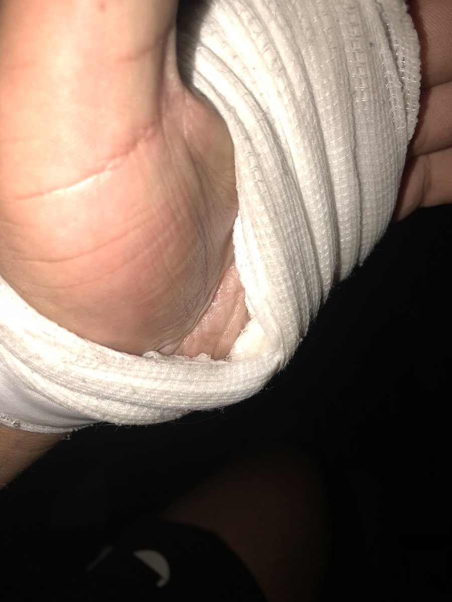 ivanlopez4998's tweet photo. Second degree burns ain’t no joke https://t.co/bUeO4MpXrW