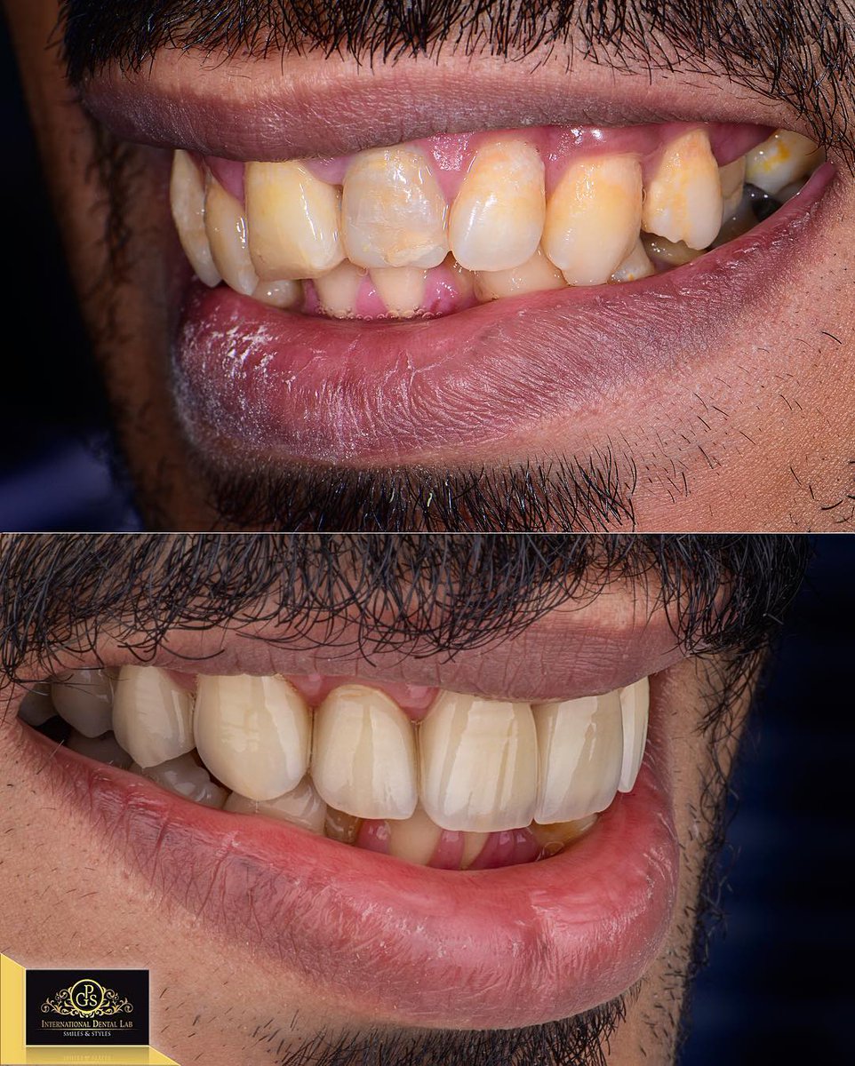 dental_gps_me's tweet photo. Repost: #LookNormal and #JustNatural .
#veneers #emax #ivoclarvivadent #smile #makeuptutorial #dental #dentist #dentalphotography #dentallab #hollywoodsmile #gps_international_dental_lab #gps_smiledesign #gps_lab https://t.co/gR5C6ACjX1
