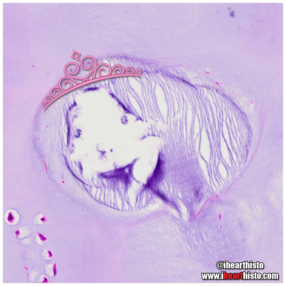 👸🏼Princess Hyaline👸🏼
Elegant on the outside and a badass machine of strength and support on the inside. She constantly outperforms the best while working under immense pressure on a daily basis.
#articularcartilage #anatomy #pathology #histology #pathArt