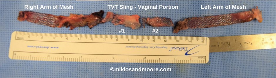 Must-read case study of a patient with an undiagnosed painful #TVTSling by #GeorgetownUniversity. She got 100% of the mesh removed by #meshremoval surgeons & #topdoctors #MIKLOSANDMOORE. #successstory #meshcomplications #meshsurgery #meshpain miklosandmoore.com/general/mesh-r…